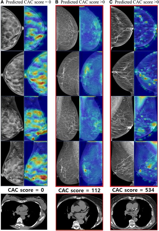 Heatmap of the zero CAC and non-zero CAC cases. The heatmap illustrates the application of our proposed method using deep learning system employing a contrastive learning strategy. The images in the first column represent participants with CAC score = 0, while the following two columns of images depict participants with CAC score > 0. (A) The breast tissue is exceptionally dense with no other abnormalities detected. (B) There are scattered fibroglandular densities in both breasts, along with benign calcifications in left breast. (C) Almost entirely fatty breasts parenchyma is observed, with benign vascular calcifications in both breasts. Please note that our model relied on CAC scores extracted from radiologists’ reports, rather than the images themselves.