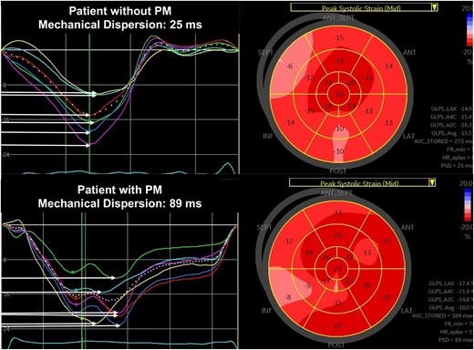 LV MeDi analysis by STE. MeDi is the SD of contraction durations from QRS peak in ECG to peak systolic strain. Horizontal arrows indicate contraction durations in each segment, and MeDi is shown as ‘Peak strain dispersion (PSD)’ in bulls-eye plot of peak systolic strain. Upper panel: normal MeDi in a patient without the need for PM. Lower panel: prolonged MeDi in a patient in need for PM after TAVI.