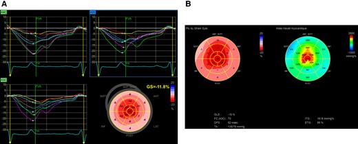 (A) An LV GLS calculation. (B) Example of ‘bull’s eye’, obtained as described above. On the left, the representation of the GLS. On the right, the myocardial work.