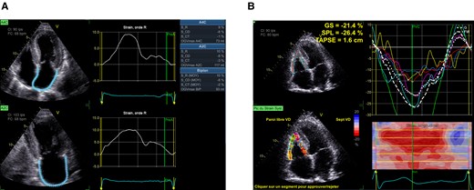 (A) LAS measurement (R, reservoir phase; CD, conduit phase; CT, contraction phase). (B) RV strain measurement.