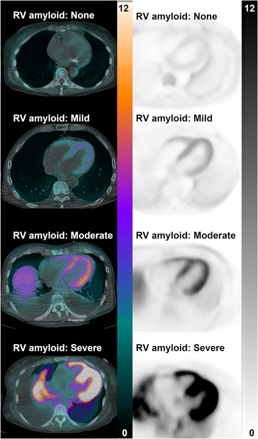 These representative PET/CT and PET images from four participants with systemic light-chain amyloidosis show no, mild, moderate, and severe 18F-florbetapir uptake in the right (and left) ventricle. Scales are in SUV. PET/CT, positron emission tomography/computed tomography.