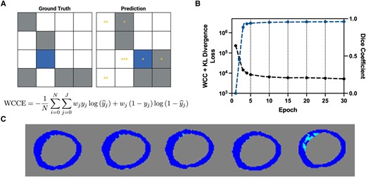 Schematic of adaptive weighted cross-entropy. (A) Representative schematic and equation of adaptive weighted cross-entropy. On the left is the ground truth and on the right is a schematic of the prediction. Grey pixels correspond to the majority non-background class and blue to the minority class. Yellow asterisks correspond to the weight. A non-background pixel that is predicted to be background is weighed based on the relative number of non-background pixels in the ground truth. (B) Loss (black) and Dice coefficient (blue) for the first 30 epochs. Vertical dashed lines correspond to weight updates, which occur every 5 epochs. (C) Segmentations from the weights every 15 epochs. The last image segmentation map corresponds to that from the weights at the end of training. Dark blue corresponds to myocardium and light blue to scar. KL, Kullback-Leibler divergence; WCC, weighted categorical cross-entropy.