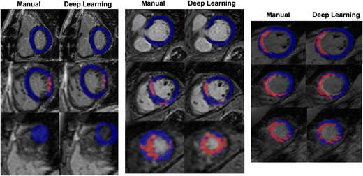 Representative deep learning segmentation. Deep learning and manual segmentations for three selected studies in the test set. Myocardial voxels are shaded in blue, while scar voxels are shaded in red. Left: 68-year-old Caucasian female, BMI 26 kg/m2, LV End Diastolic Volume (EDV) 140 mL, 8% scar, field strength 3 T. Middle: 49-year-old Asian male, BMI 30 kg/m2, LV EDV 172 mL, 16% scar, field strength 1.5 T. Right: 36-year-old Caucasian male, BMI 21 kg/m2, LV EDV 220 mL, 23% scar, field strength 1.5 T.