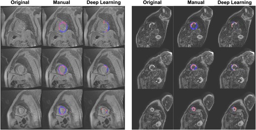 Representative deep learning segmentation failures. Myocardial voxels are shaded in blue, while scar voxels are shaded in red.