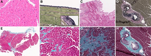 Histomorphology findings. (A) Cardiomyocyte hypertrophy in cross-section (haematoxylin–eosin × 100); this was an invariable finding at EMB; (B) mild sub-endocardial elastosis at elastic van Gieson’s stain (×100). Detail of elastic fibres (box) from another patient with prominent endocardial thickening (×200); (C) herringbone architecture pattern defining myocardial disarray (haematoxylin–eosin × 100), which was present in 15.5% of the samples; (D) intra-myocardial dysplastic arteries put in evidence at elastic van Gieson’s stain (×40), with media thickening, elastic extra-deposition, and luminal distortion; (E) overview of a biopsy specimen with endocardial inclusion (Masson’s Trichrome × 10); (F) coalescent areas of interstitial fibrosis described as microscars (arrowhead) (Masson’s Trichrome × 40); (G) large area of replacement fibrosis (*) (Masson’s Trichrome × 100); (H) extensive perivascular fibrosis (Masson’s Trichrome × 40, same area as D).