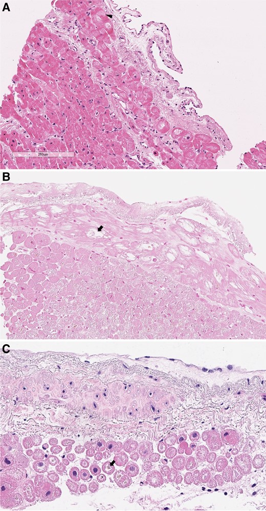 (A–C) Examples of abnormal sub-endocardial cardiomyocyte morphology, present in 45% of the samples with endocardial inclusion. At haematoxylin–eosin × 100 it is possible to identify cytoplasmatic enlargement, vacuolization (arrow) and myofibre detachment (arrowhead).