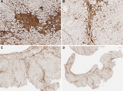 (A–D) Type I collagen immunohistochemistry. In A (×100), there is positivity at an area of coalescent fibrosis, previously identified at Masson’s Trichrome stain. From B to D (same case at ×40, ×20 and ×10), there is centripetal distribution of positive staining, towards the intra-myocardial vessel web.