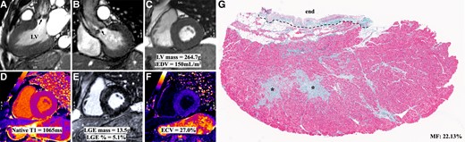 Co-registered pre-operative CMR data and invasive quantification of MF from one of the patients of the cohort (marked with an arrow in Figure 5C). * in G represents areas of large coalescent substitution fibrosis.