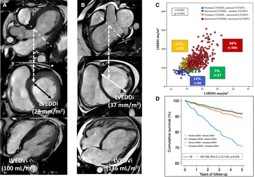 Left ventricular dilatation based on linear dimension (left ventricular end-diastolic diameter) or volumetric dimension (left ventricular end-diastolic volume) vs prognosis. Panel A shows the 3-chamber reconstruction of the left ventricle from a cardiac magnetic resonance (CMR) cine image. The dotted line demarcates the plane where the short-axis of the left ventricle is acquired and where the left ventricular endi-diastolic diameter is measured and indexed , LVEDDi). The 4-chamber view of the left ventricle is shown and the left ventricular end-diastolic volume is measured from stacks of short-axis and indexed to body surface area (LVEDVi). In this case, the LVEDDi is non-dilated whereas the LVEDVi is dilated. Panel B shows the CMR data of a patient with dilated left ventricle based on LVEDDi and LVEDVi. Panel C shows the correlation between LVEDDi and LVEDVi and the 4 groups of patients based on the dilatation of one or the other dimension or both. Panel D shows the cumulative survival curves for each group of patients.