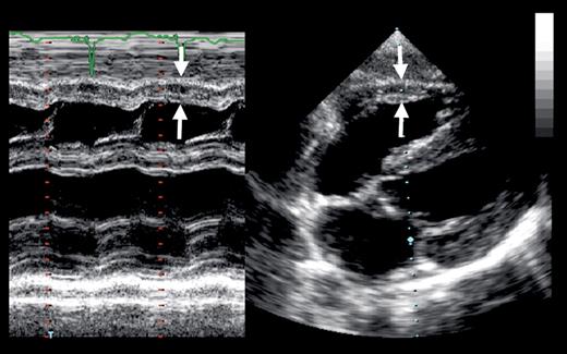 Methods of measuring right ventricular wall thickness (arrows) from an M-mode echo (left) and a ...