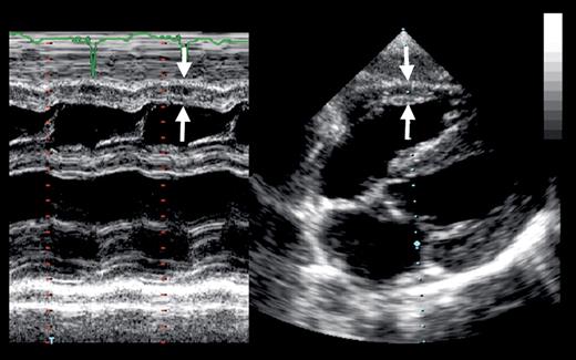 Methods of measuring right ventricular wall thickness (arrows) from an ...