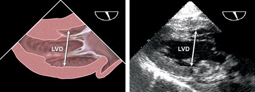 Transesophageal echo measurements of left ventricular minor axis diameter (LVD) from the trans ...