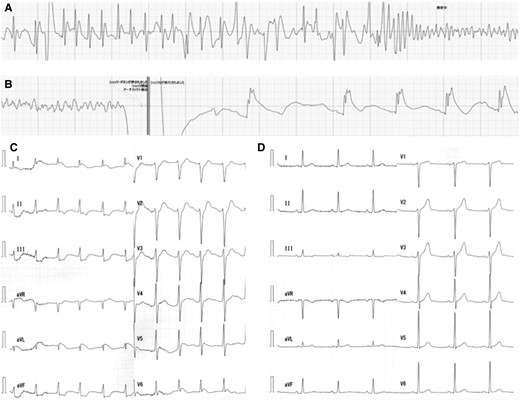 (A) After appropriate electrical cardioversion was delivered four times, transient sinus rhythm was obtained but ventricular fibrillation returned. (B) After two more shocks, the automated external defibrillator ECG showed termination of ventricular fibrillation and ST-segment elevation. (C) After termination of ventricular fibrillation, 12 lead ECG showed ST-segment elevation in the lateral leads and ST-segment depression in the inferior leads. (D) After the acute phase passed, his ECG was completely normal.