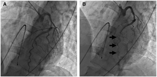 (A) LAO cranial view of the left coronary artery at baseline. (B) LAO cranial view of the left coronary artery after intracoronary injection of 20 μg of acetylcholine into it. It induced spasm of the distal portion of the left anterior descending artery (black arrows).