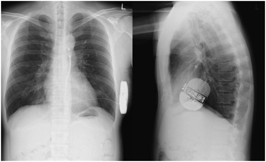 The chest X-ray after implantation of the subcutaneous implantable cardioverter-defibrillator.