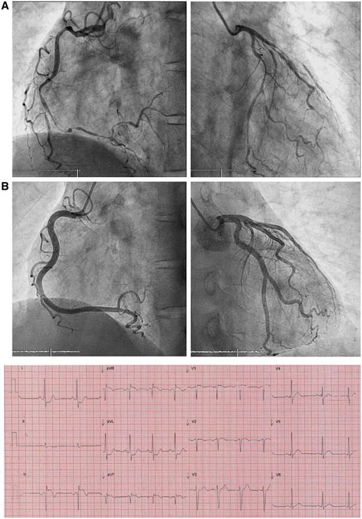 Presenting electrocardiogram and coronary angiography. Electrocardiogram showing inferior ST-segment elevation myocardial infarction. Coronary angiography at the time of presentation (A) showed unusually severe widespread luminal stenosis throughout the coronary trees despite administration of 500 μg of intracoronary glyceryl trinitrate; repeat angiography (B) after 4 weeks of immunosuppression showed complete resolution—note the smooth contour of the vessel wall devoid of atheroma (Standard LAO view for RCA and PA/slight RAO caudal view for LCA projection—please refer to Supplementary material online, Video clips for more detailed angiography).
