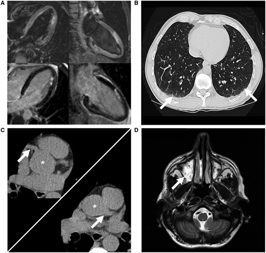 Multi-modal investigation to support eosinophilic granulomatosis with polyangiitis diagnosis. Cardiac magnetic resonance imaging (A) showing acute myocardial infarction in the apical anterior and anterolateral walls but no myocarditis; computed tomography thorax (B) showing multiple tiny pulmonary nodules and small patches of ground-glass appearance (arrows) in the lung bases; cardiac computed tomography (C) showing no coronary calcification with an Agatston score of zero; asterisk denotes aortic root with left arrow at the right coronary artery and right arrow at the left main coronary artery; head magnetic resonance imaging (D) showing complete opacification of the maxillary sinuses (arrow).