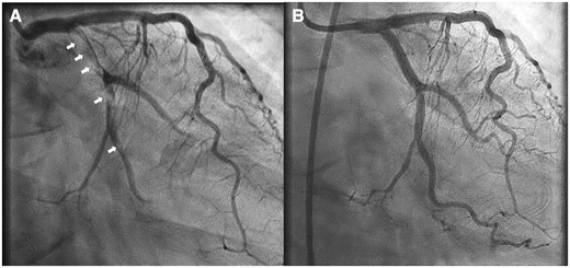 Right anterior oblique caudal coronary angiogram shows extensive thrombosis (arrows) of the circumflex artery (A) and excellent post-percutaneous coronary intervention result (B).