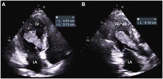 Transthoracic apical four-chamber view of the mass (A) and apical three-chamber view (B). LA, left atrium; LV, left ventricle.