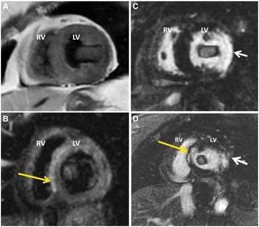Short-axis double inversion recovery (A) and triple inversion recovery (B) images demonstrate an ovoid mass that is approximately isointense to myocardium. The triple inversion recovery images emphasize T2 (fluid) signal and employ a Short TI Inversion Recovery (STIR) pulse as part of the three inversion sequences to suppress fat. Post-contrast short axis (C) and three-chamber (D) myocardial late enhancement images at short TI shows ‘enhancement’ of mass likely due to short TI that led to confusion of potential myxoma. Late enhancement images also demonstrate a full thickness lateral wall myocardial infarction (white arrows), which are more consistent with adherent thrombus. High signal intensity in the septum on T2 is likely small septal infarct that is also demonstrated on delayed enhancement (yellow arrows). LV, left ventricle; RV, right ventricle.