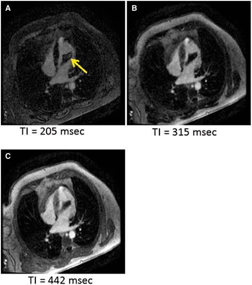 Images from TI scout sequence. TI 205 ms (A) shows central bright area in mass (yellow arrow), which was also seen on the delayed enhancement image and is likely due to short TI (thrombus not nulled). Note: bright area is not see at other time points (B) and (C).