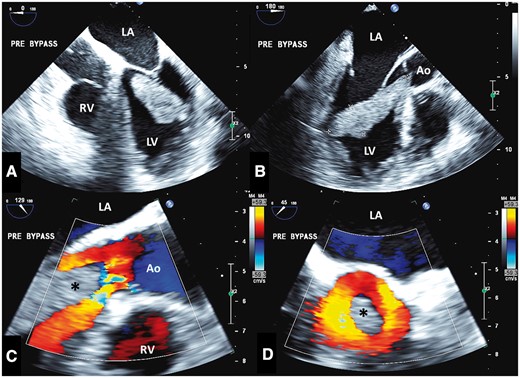 (A) Pre-bypass IOTEE shows mass in four-chamber format (A) and long-axis format (B). The zoomed long-axis (C) and short-axis (D) views of the left ventricular outflow tract show the mass (asterisk) protruding with preserved mostly laminar systolic flow (colour Doppler) around it. Ao, aorta; IOTEE: intraoperative transoesophageal echocardiography; LA, left atrium; LV, left ventricle; RV, right ventricle.