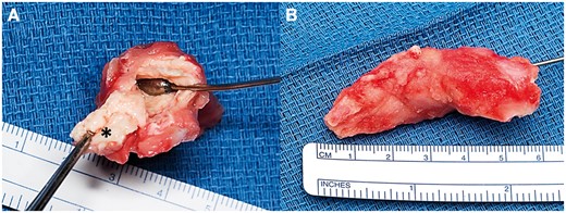 Intraoperative photographs of the excised left ventricular mass reveal a tan-red, somewhat friable mass (A and B) with a firm attachment to the subjacent endocardium (asterisk, A).