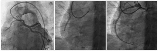 Coronary angiogram of single coronary artery engaged with Amplatz left guide catheter showing normal left anterior descending artery and left circumflex artery and occluded right coronary artery (RCA) arising at an acute angle from the common trunk. It also shows implantation of a drug eluting stent with good result in the anomalous RCA.