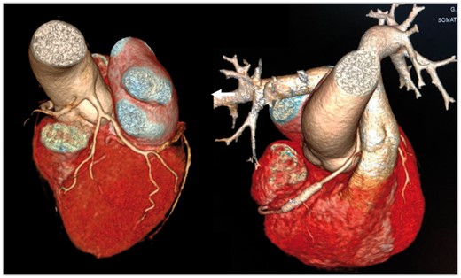 Computed tomography coronary angiography showing origin of single coronary trunk above the left sinus from ascending aorta and normal left coronary system. The right coronary artery (RCA) is coursing between aorta and pulmonary artery. It shows a well deployed stent in mid-RCA.