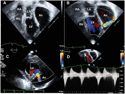 Transthoracic echocardiogram on Epiq 7 platform (Philips N.V, Netherlands) from apical view (A) shows a very large pseudoaneurysm with a narrow neck from the posterolateral wall of the left ventricle extending superiorly to the left of left atrium. The right atrium and right ventricle are normal in size. Colour Doppler imaging demonstrates systolic flows into the aneurysm in apical view (B). The mouth of the aneurysm is located between the two heads of papillary muscles of the left ventricle (C). To-and-fro flows on spectral Doppler (D) demonstrates ineffective left ventricular contractility. An, pseudoaneurysm; LA, left atrium; LV, left ventricle; RA, right atrium; RV, right ventricle.
