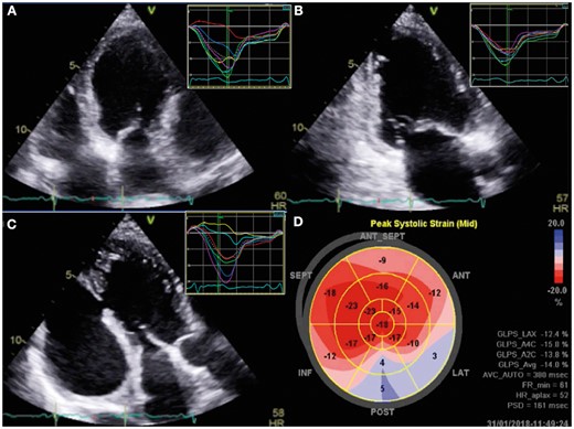 Speckle imaging on Vivid E95 platform (GE Health care, Solingen, Germany) from four chamber (A), two chamber (B), and three chamber (C) views demonstrated normal segmental strain in anterior, anteroseptal and septal walls and post-systolic shortening with positive strain in posterior and lateral walls. The polar bull’s eye map shows the segmental differences in strain.