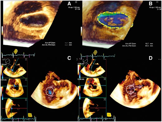 Three-dimensional transoesophageal echocardiogram in Acuson SC2000 prime platform (Siemens, Muenchen, Germany) shows left atrial view of the distorted mitral annulus, which is flattened by the posterior large pseudoanerysm (A) clearly demonstrated in eSie mitral analysis (B). Volume rendered three chamber view in diastole (C) and systole (D) shows the to-and-fro flows into and out of the mouth of the pseudoaneurysm.