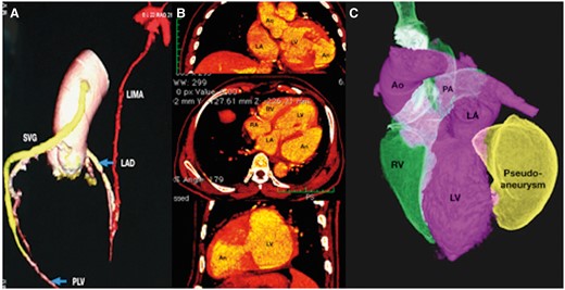 Multislice gated computed tomography (A) demonstrates patent internal mammary graft to left anterior descending coronary artery shown in red colour and venous graft from ascending aorta to posterolateral ventricular branch of right coronary artery shown in yellow colour. Multiplanar reformatted images in coronal, axial, and parasagittal planes (B) shows the mouth of the pseudoaneurysm from the left ventricle. A volume rendered image shows the large pseudoaneurysm shown in yellow arising from the posterolateral wall of the left ventricle.