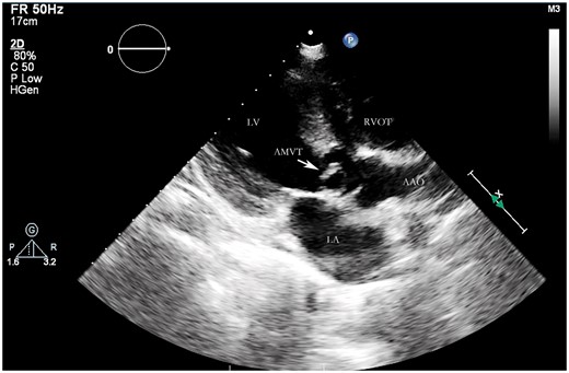 The parasternal long-axis view showed a fixed accessory mitral valve tissue attached to the anterior leaflet, which caused left ventricular outflow tract obstruction.