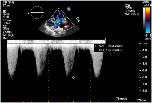 Apical five-chamber view: continuous wave Doppler examination showed the peak flow velocity across left ventricular outflow tract was 5.04 m/s.