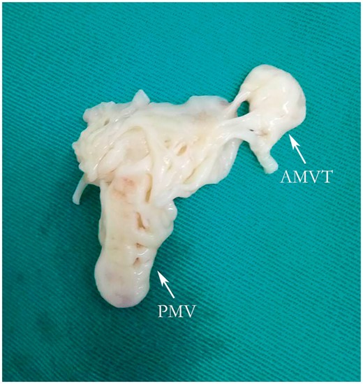 AMVT and PMV after resection. AMVT, accessory mitral valve tissue; PMV, parachute mitral valve.