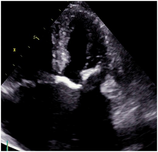 Transthoracic echocardiogram showing a massive calcified mitral stenosis.