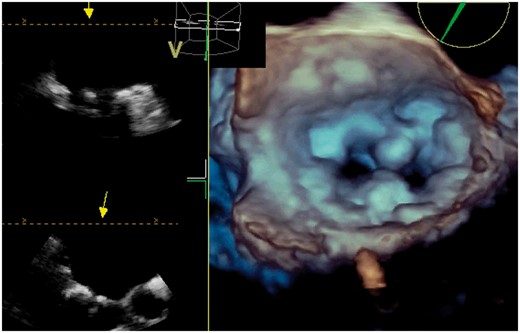 Calcified mitral stenosis imitates a MitraClip® in three-dimensional transoesophageal echocardiogram.
