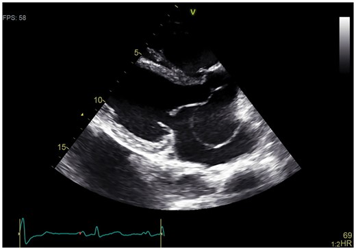 Transthoracic echocardiography showing a giant aneurysm of the sinus of Valsalva of the non-coronary aortic cusp.