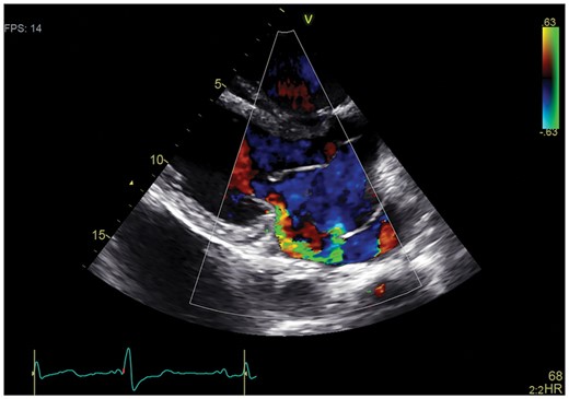 Transthoracic echocardiography showing colour Doppler flow with a shunt between the aneurysm and left atrium.