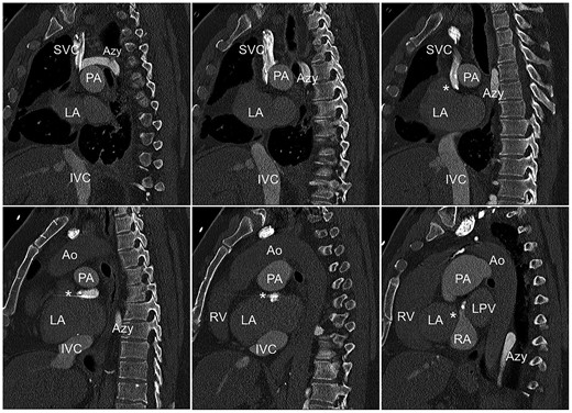 Reconstruction of a pre-operative computed tomography scan showing the narrow baffle (asterisk) and the two atrial leads. Ao, aorta; Azy, azygos vein; IVC, inferior vena cava; LA, left atrium; PA, pulmonary artery; RA, right atrium; SVC, superior vena cava.