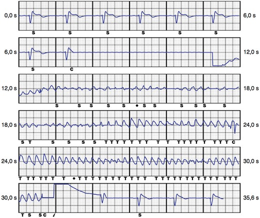 Subcutaneous implantable cardioverter defibrillator EGM of the secondary vector during intraoperative shock testing. C, charging; S, sensed event; T, tachycardia detection.