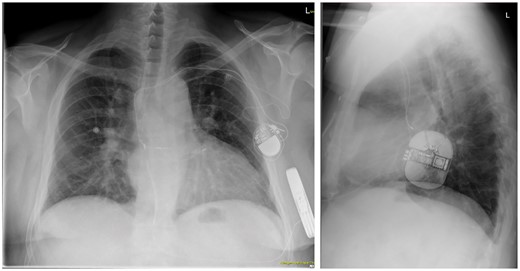 Post-operative chest X-ray in posteroanterior and left-lateral projection, showing the right parasternal lead position (left panel, patient not centred note processi spinosi projection).