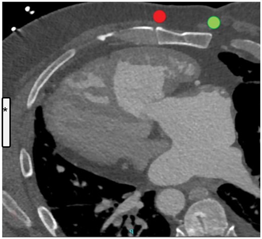 Pre-operative computed tomography scan showing the dilated right ventricle and its relation to the sternum and the left hemithorax. The left atrium drains into the right ventricle after the atrial switch surgery. Superimposed are the estimated locations of the subcutaneous implantable cardioverter defibrillator (asterisk) and a right (green) or left (red) parasternal lead position.