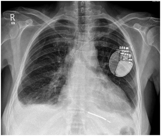 Initial chest X-ray demonstrating bilateral pleural effusions and patchy bilateral bronchopneumonic changes. Single lead implantable cardioverter-defibrillator in situ.