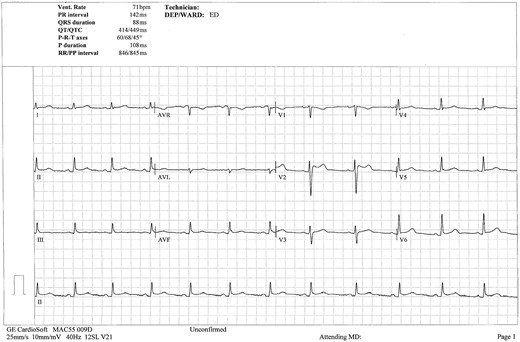 Electrocardiogram demonstrating sinus rhythm with J-point elevation in lead V2 consistent with a Brugada pattern.