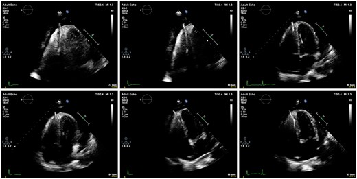 Series of echocardiographic images demonstrating perforation of lead through the right ventricular apex with associated global pericardial effusion in the four-chamber view.