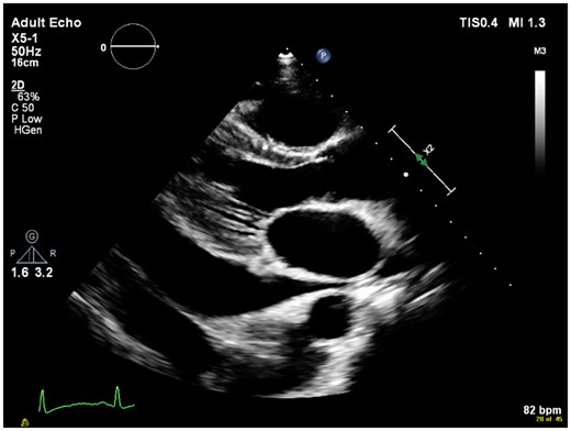 Echocardiographic parasternal long-axis view.