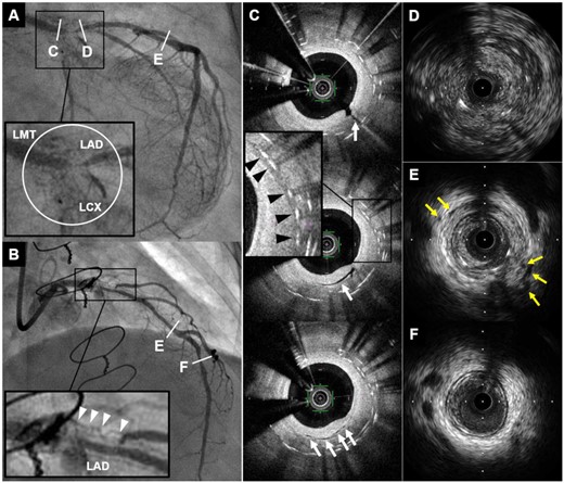 Coronary angiogram and intracoronary imaging findings of Case 1. (A and B) Coronary angiogram demonstrated severe in-stent restenosis with remarkable proliferated neovascularization around the stented segment (white circle and white arrowheads) in distal left main trunk to ostium of left anterior descending artery and left circumflex coronary artery. (C) Optical coherence tomography revealed multiple microvessels communicating with lumen (white arrows) and peri-strut low intensity area (black arrowheads) within neointima. (D–F) Intravascular ultrasound showed ambiguous three-layered structure within the stented and non-stented segments (D), and various degrees of peri-arterial low-echoic area and peri-arterial small vessels (yellow arrows) within stents and near distal stent edge (E). In contrast, these findings were not apparent in distal left anterior descending artery (F). CAG, coronary angiography; IVUS, intravascular ultrasound; LAD, left anterior descending artery; LCX, left circumflex coronary artery; LMT, left main trunk; OCT, optical coherence tomography; PLEA, peri-arterial low-echoic area.