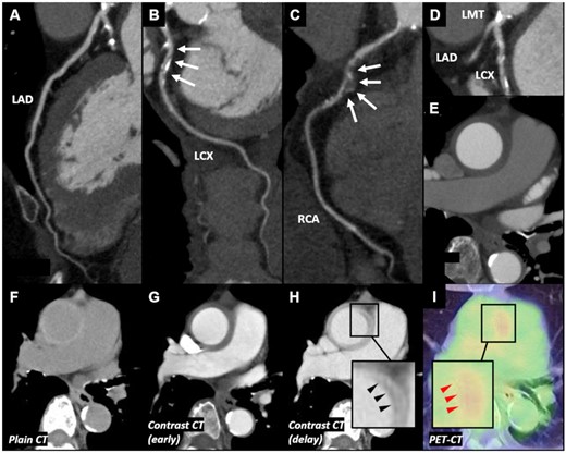 Computed tomography, computed tomography angiography, and positron emission tomography–computed tomography findings of Case 2. (A) No significant stenosis was observed in left anterior descending artery. (B) Significant stenosis was observed in left circumflex coronary artery. (C) Significant stenosis with aneurysm was observed in mid-right coronary artery. (D) Significant stenosis with calcification was observed in left main trunk. (E) Concentric wall thickening of the ascending aorta was observed. (F) Plain computed tomography showed concentric thickened high-attenuation wall of ascending aorta. (G) Contrast-enhanced computed tomography showed that the thickened wall appeared with low-attenuation. (H) Delayed phase contrast-enhanced computed tomography showed ‘double ring enhancement’ (black arrowheads). (I) Positron emission tomography–computed tomography revealed increased F-18 fluorodeoxyglucose uptake in the wall of ascending aorta, especially a part of ‘double ring enhancement’ (red arrowheads). CAG, coronary angiography; CT, computed tomography; CTA, computed tomography angiography; IVUS, intravascular ultrasound; LAD, left anterior descending artery; LCX, left circumflex coronary artery; LMT, left main trunk; OCT, optical coherence tomography; PET, positron emission tomography; PLEA, peri-arterial low-echoic area; RCA, right coronary artery.